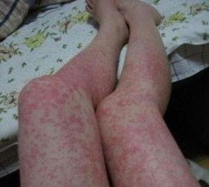 美国产品过敏事件视频,惊心动魄的生存挑战